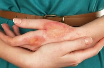 Як лікувати опіки вдома: ефективні засоби та поради для кожного