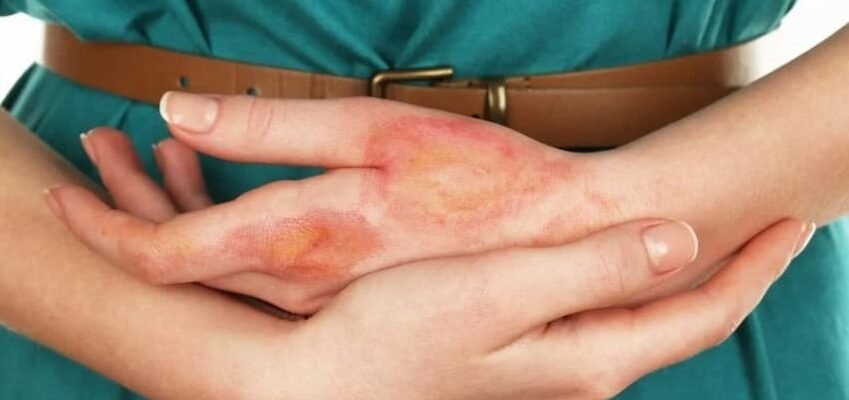 Як лікувати опіки вдома: ефективні засоби та поради для кожного