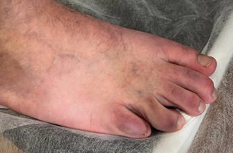 Як лікувати посиніння нігтя на нозі після удару: поради та методи