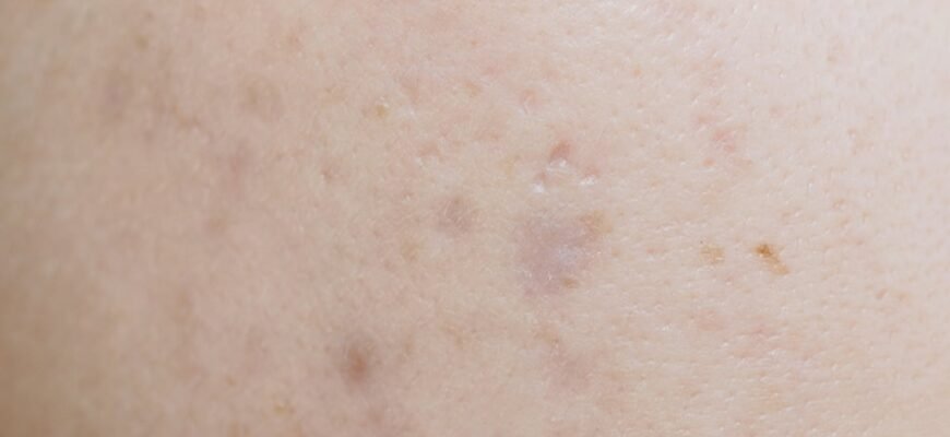 Як позбутися плям від прищів вдома: ефективні методи та засоби