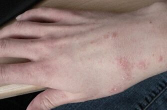 Як розрізнити симптоми корости та алергії: поради та рекомендації