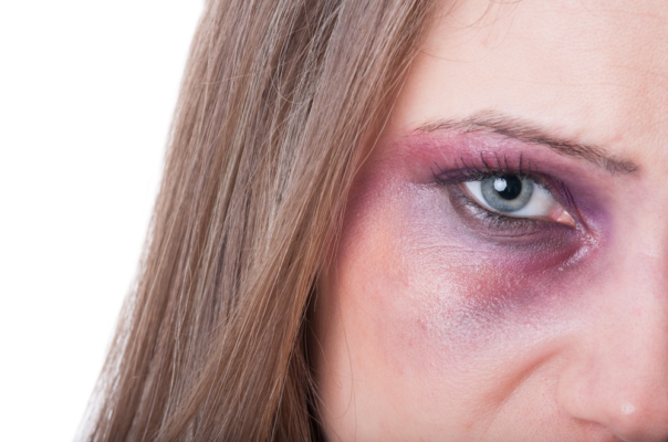 Як швидко позбутися синяка під оком після удару: ефективні методи