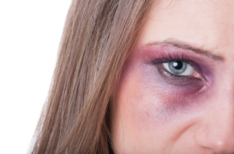 Як швидко позбутися синяка під оком після удару: ефективні методи