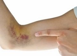 Як швидко та ефективно позбутися синяків після уколів: практичні поради