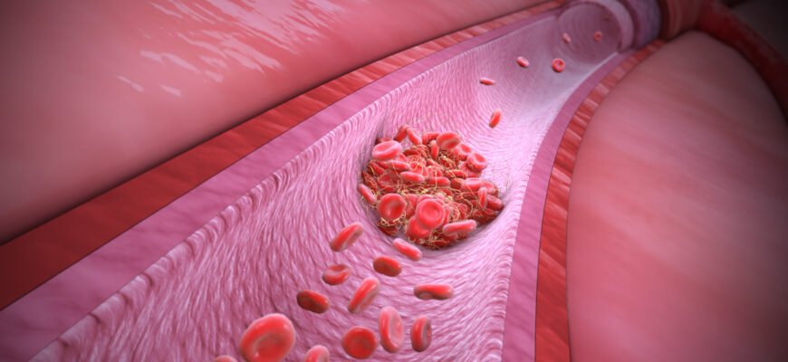Як трапляється смерть від тромбу: основні причини та попередження