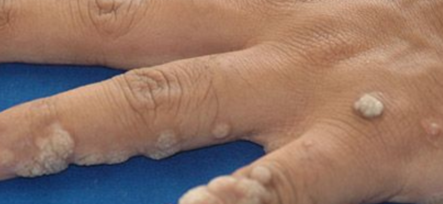 Як уникнути опіку від чистотілу: поради та лікування наслідків