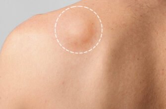 Як відрізнити жировик від пухлини: поради для правильного діагнозу