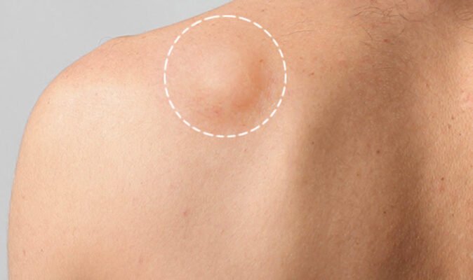 Як відрізнити жировик від пухлини: поради для правильного діагнозу