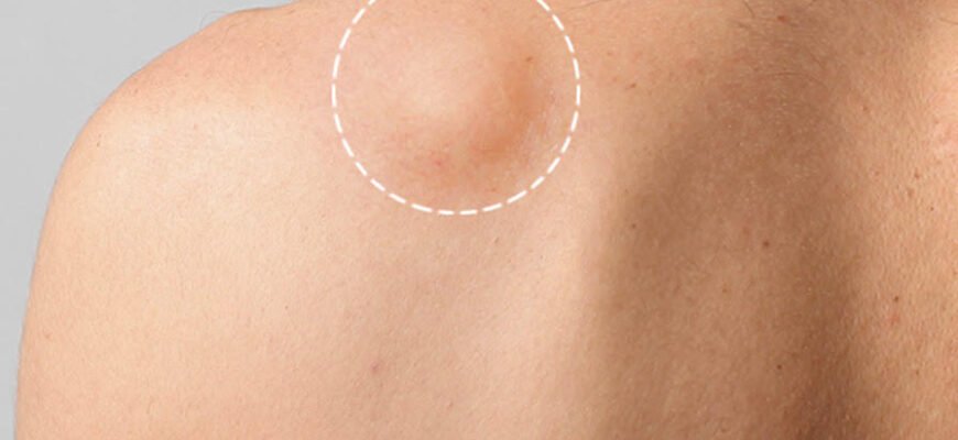 Як відрізнити жировик від пухлини: поради для правильного діагнозу